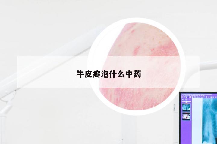 牛皮癣泡什么中药