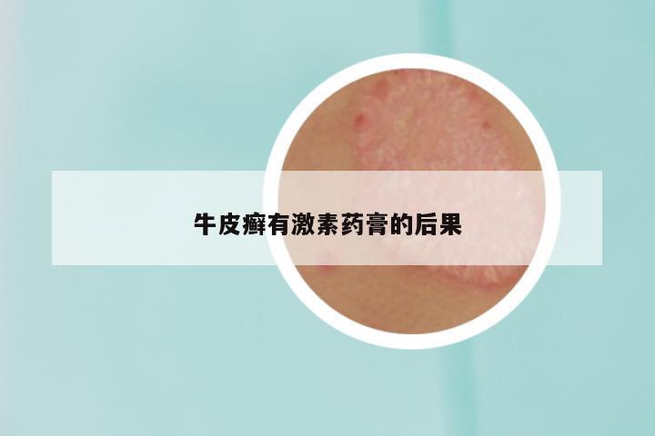 牛皮癣有激素药膏的后果