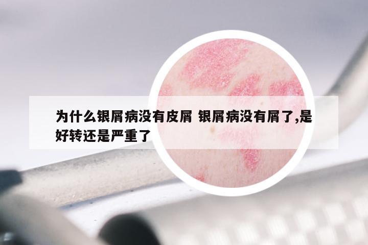 为什么银屑病没有皮屑 银屑病没有屑了,是好转还是严重了