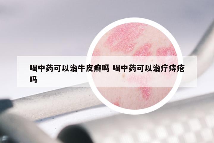 喝中药可以治牛皮癣吗 喝中药可以治疗痔疮吗