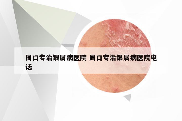 周口专治银屑病医院 周口专治银屑病医院电话