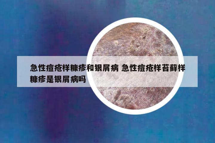 急性痘疮样糠疹和银屑病 急性痘疮样苔藓样糠疹是银屑病吗