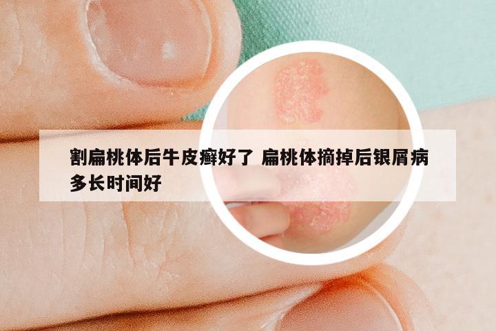 割扁桃体后牛皮癣好了 扁桃体摘掉后银屑病多长时间好
