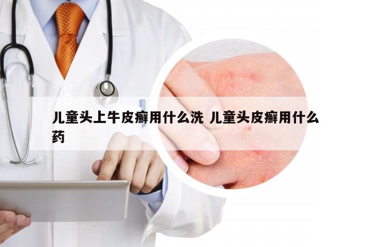 儿童头上牛皮癣用什么洗 儿童头皮癣用什么药