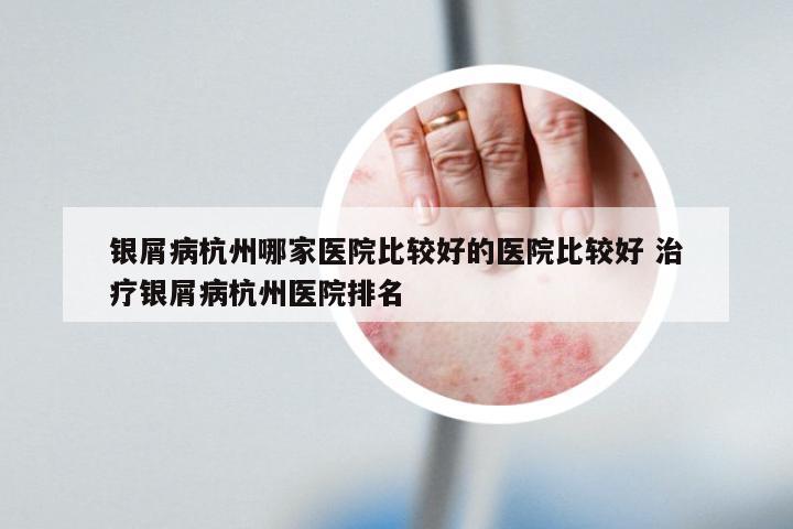银屑病杭州哪家医院比较好的医院比较好 治疗银屑病杭州医院排名