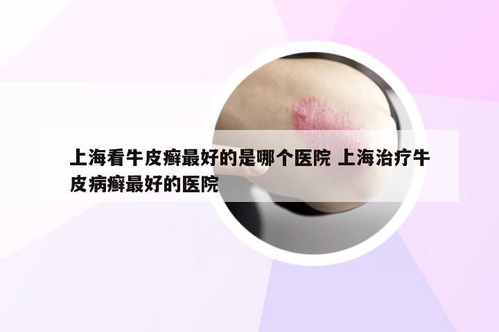 上海看牛皮癣最好的是哪个医院 上海治疗牛皮病癣最好的医院