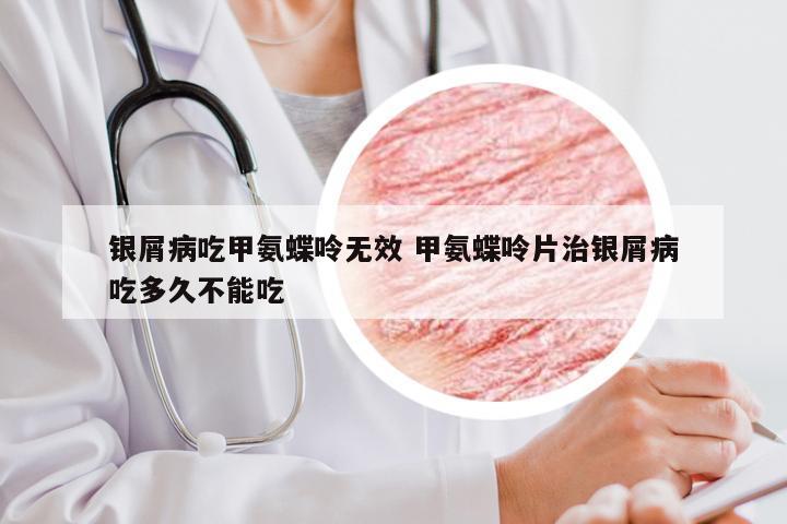 银屑病吃甲氨蝶呤无效 甲氨蝶呤片治银屑病吃多久不能吃