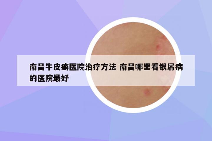 南昌牛皮癣医院治疗方法 南昌哪里看银屑病的医院最好