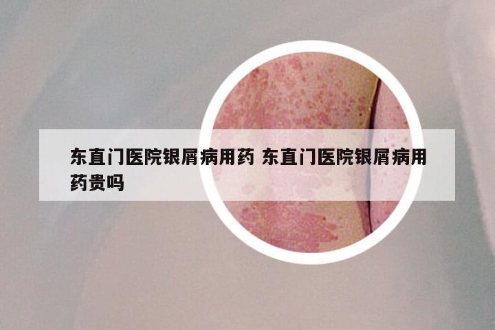 东直门医院银屑病用药 东直门医院银屑病用药贵吗