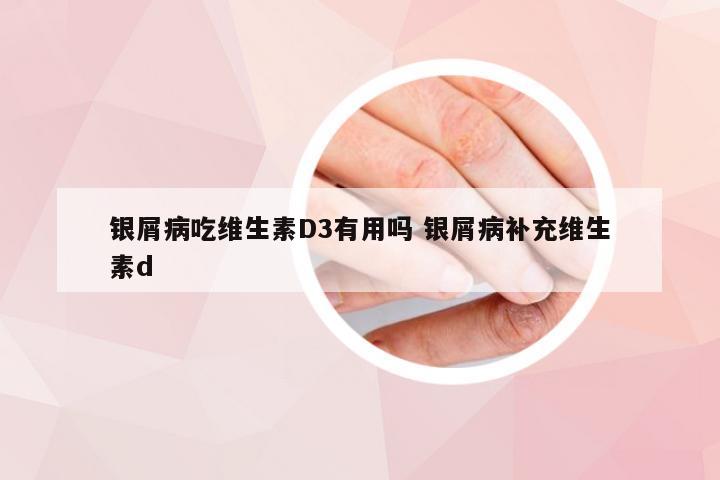 银屑病吃维生素D3有用吗 银屑病补充维生素d