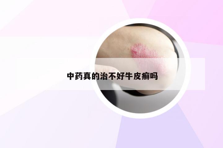 中药真的治不好牛皮癣吗