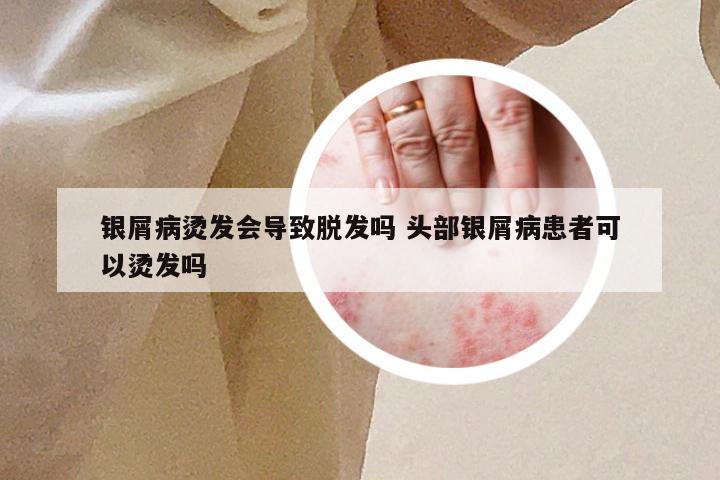 银屑病烫发会导致脱发吗 头部银屑病患者可以烫发吗