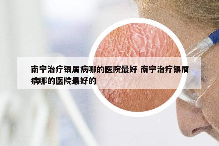 南宁治疗银屑病哪的医院最好 南宁治疗银屑病哪的医院最好的