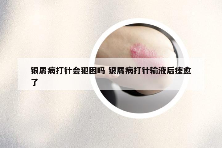 银屑病打针会犯困吗 银屑病打针输液后痊愈了