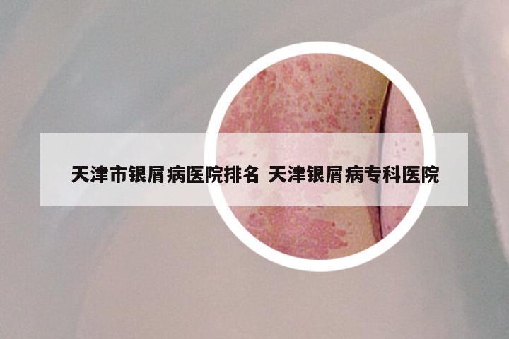 天津市银屑病医院排名 天津银屑病专科医院