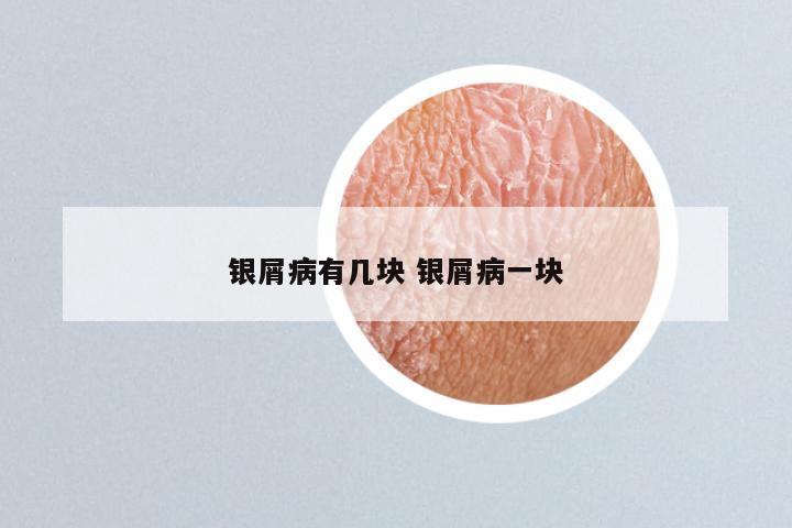银屑病有几块 银屑病一块