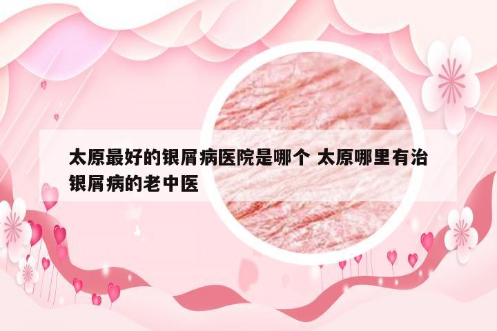 太原最好的银屑病医院是哪个 太原哪里有治银屑病的老中医