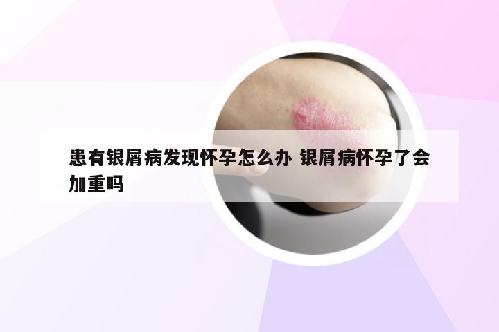 患有银屑病发现怀孕怎么办 银屑病怀孕了会加重吗