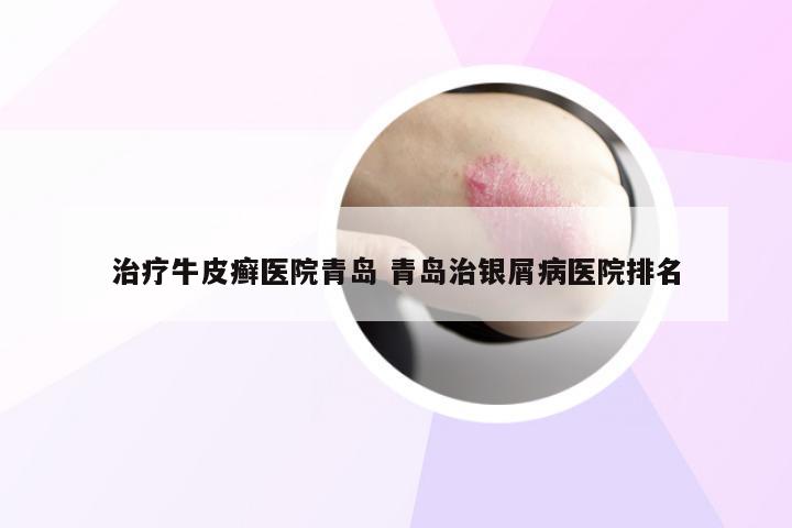 治疗牛皮癣医院青岛 青岛治银屑病医院排名