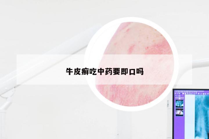 牛皮癣吃中药要即口吗