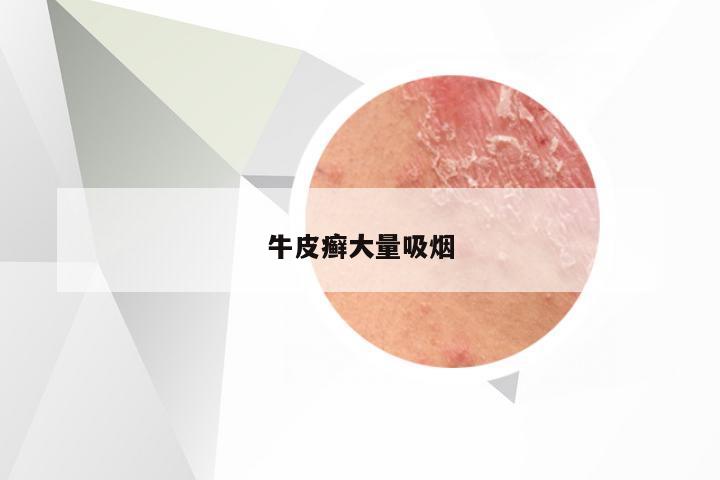 牛皮癣大量吸烟
