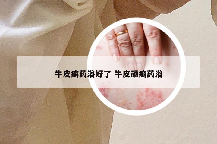 牛皮癣药浴好了 牛皮顽癣药浴