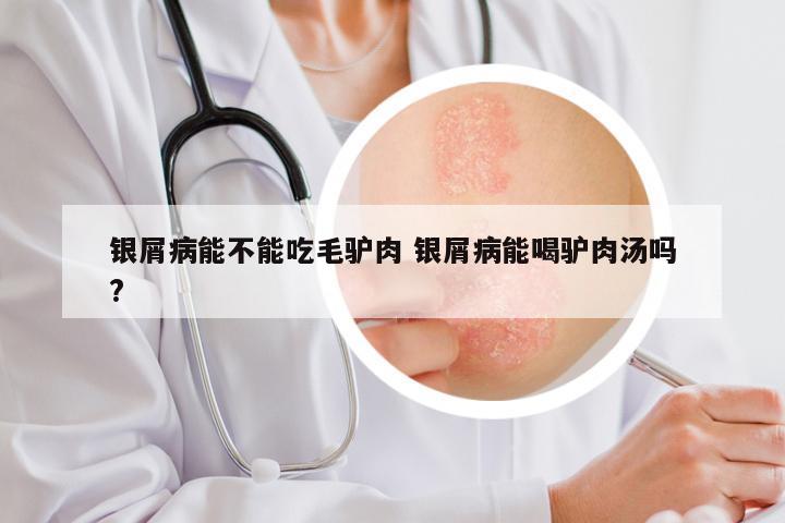 银屑病能不能吃毛驴肉 银屑病能喝驴肉汤吗?