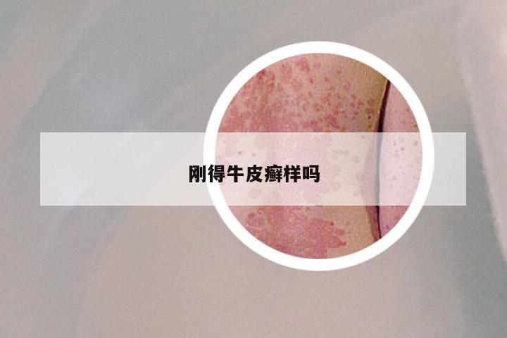 刚得牛皮癣样吗
