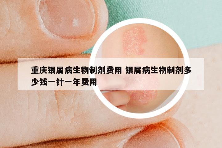 重庆银屑病生物制剂费用 银屑病生物制剂多少钱一针一年费用