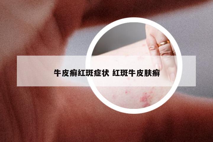 牛皮癣红斑症状 红斑牛皮肤癣