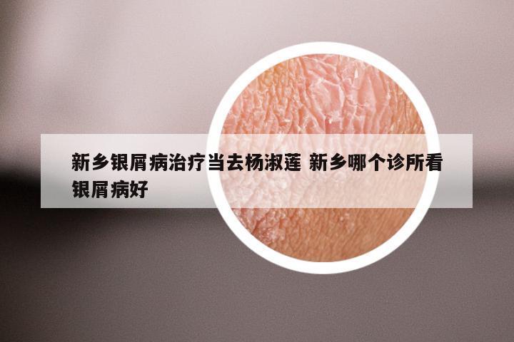 新乡银屑病治疗当去杨淑莲 新乡哪个诊所看银屑病好