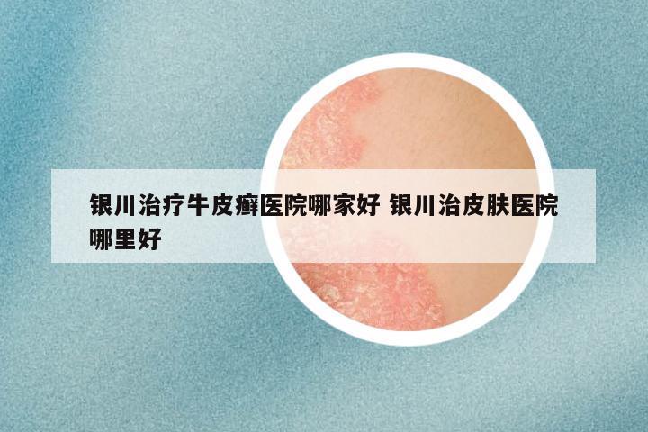 银川治疗牛皮癣医院哪家好 银川治皮肤医院哪里好