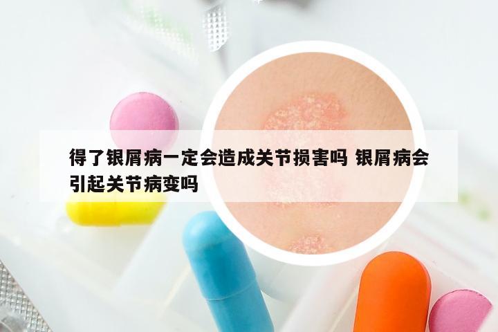 得了银屑病一定会造成关节损害吗 银屑病会引起关节病变吗