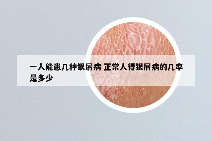 一人能患几种银屑病 正常人得银屑病的几率是多少