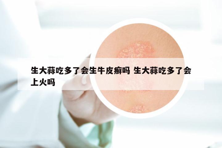 生大蒜吃多了会生牛皮癣吗 生大蒜吃多了会上火吗