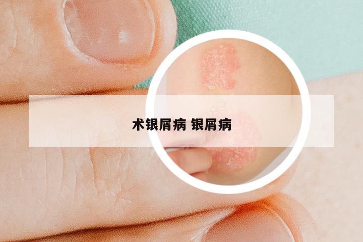 术银屑病 银屑病