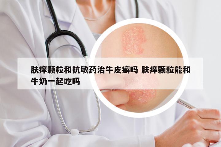 肤痒颗粒和抗敏药治牛皮癣吗 肤痒颗粒能和牛奶一起吃吗