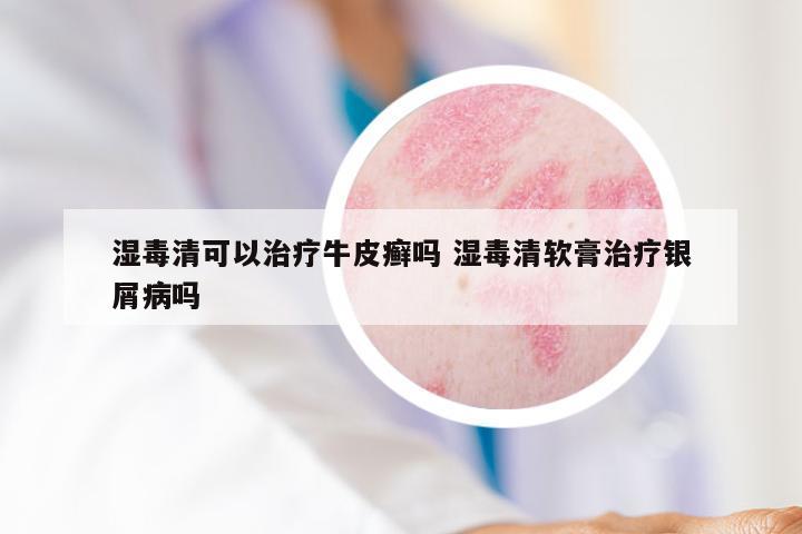 湿毒清可以治疗牛皮癣吗 湿毒清软膏治疗银屑病吗