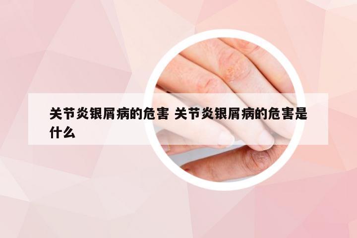 关节炎银屑病的危害 关节炎银屑病的危害是什么