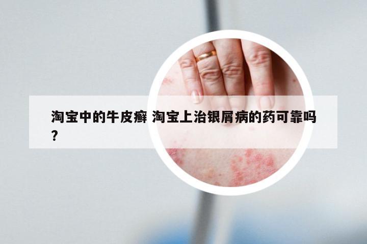 淘宝中的牛皮癣 淘宝上治银屑病的药可靠吗?