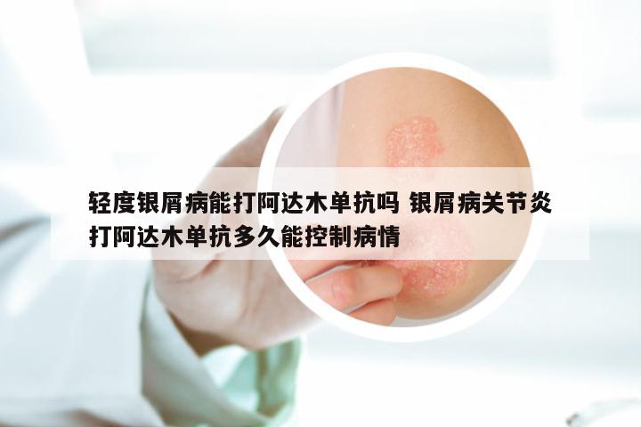 轻度银屑病能打阿达木单抗吗 银屑病关节炎打阿达木单抗多久能控制病情