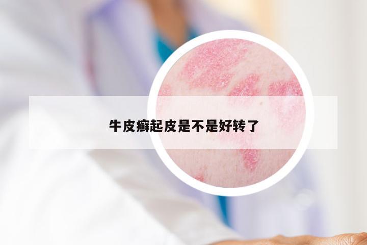 牛皮癣起皮是不是好转了