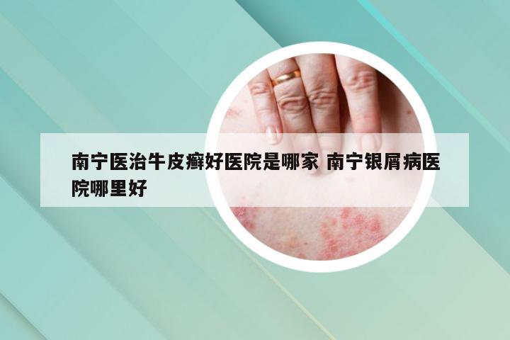 南宁医治牛皮癣好医院是哪家 南宁银屑病医院哪里好