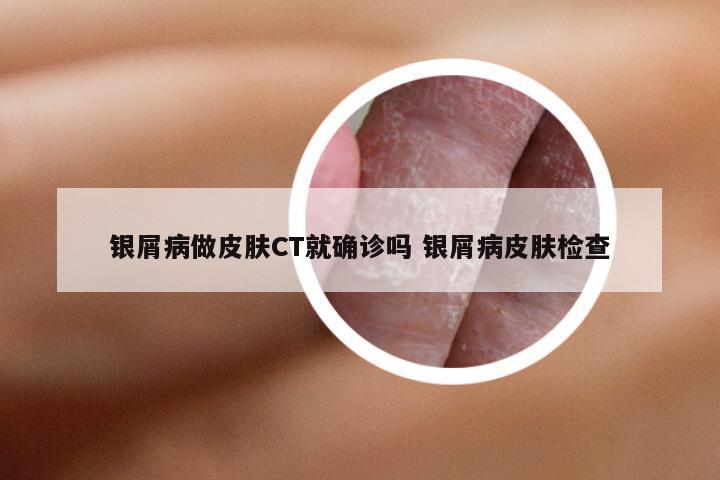 银屑病做皮肤CT就确诊吗 银屑病皮肤检查