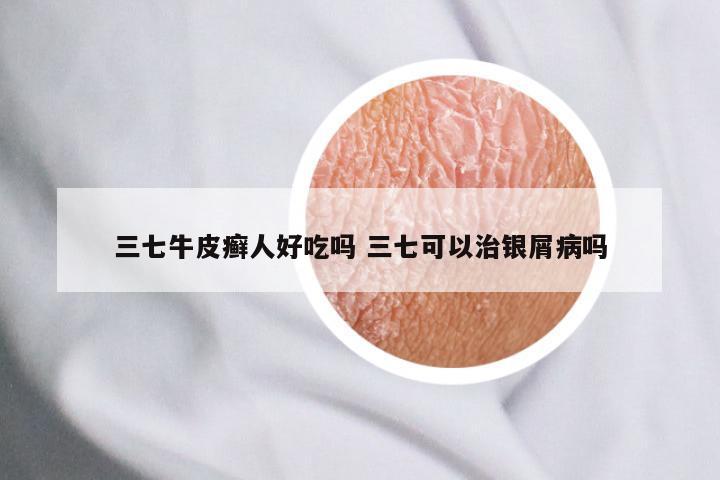 三七牛皮癣人好吃吗 三七可以治银屑病吗