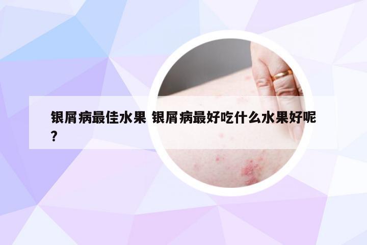 银屑病最佳水果 银屑病最好吃什么水果好呢?