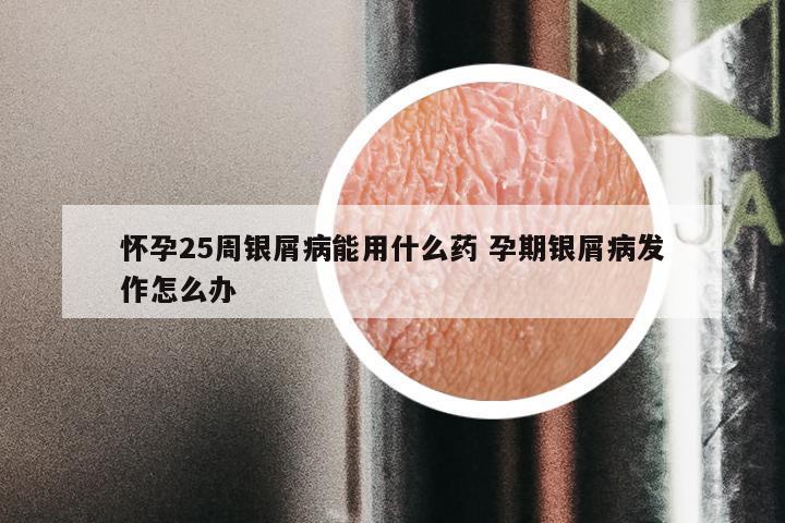 怀孕25周银屑病能用什么药 孕期银屑病发作怎么办