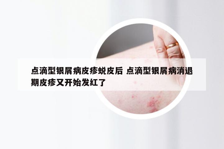 点滴型银屑病皮疹蜕皮后 点滴型银屑病消退期皮疹又开始发红了