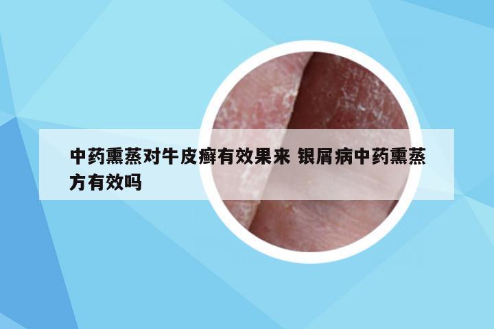 中药熏蒸对牛皮癣有效果来 银屑病中药熏蒸方有效吗