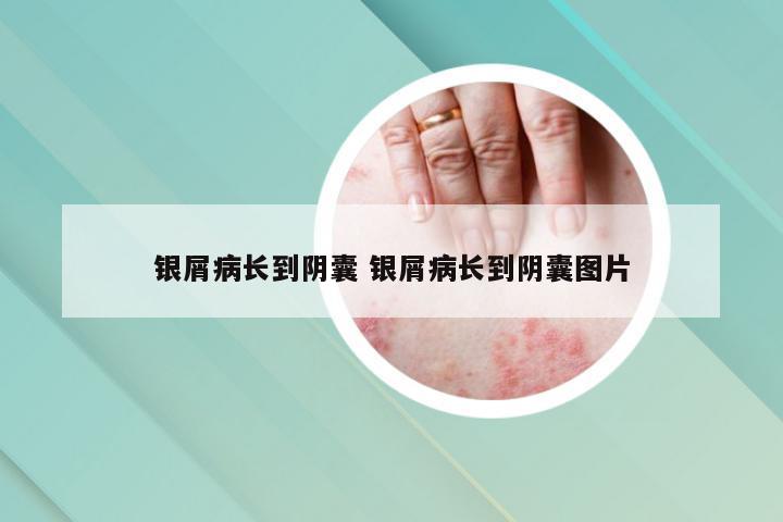 银屑病长到阴囊 银屑病长到阴囊图片